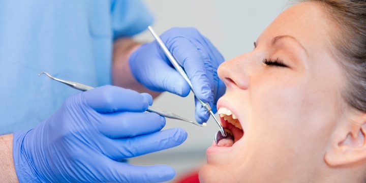 dental fillings