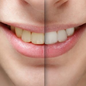 questions about teeth whitening
