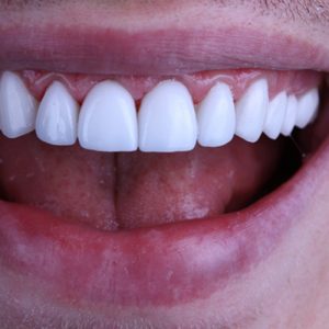 questions about veneers