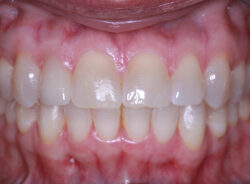 after-retracted