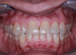 before-retracted