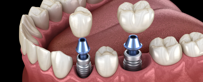 more than one dental implant at once