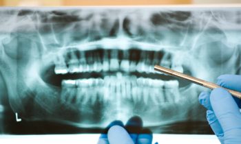 root canal explained