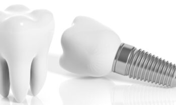 care for dental implants