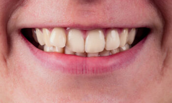 correct overlapping teeth