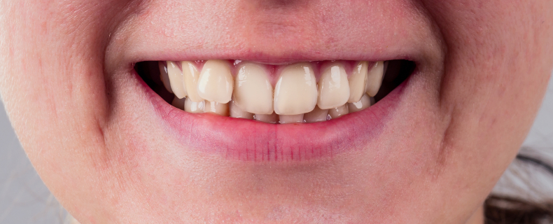 correct overlapping teeth