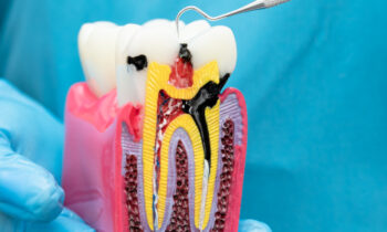 root canal