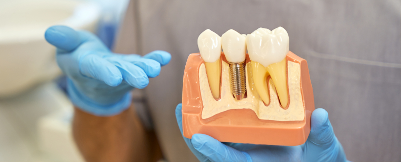 dental implant guide