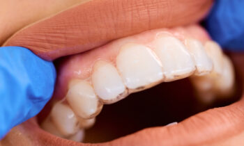 how does invisalign work