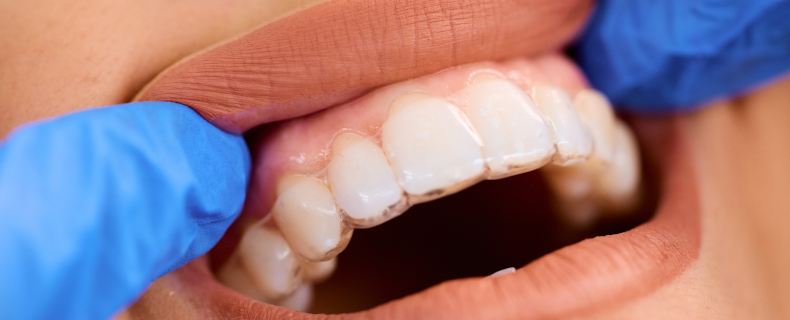 how does invisalign work
