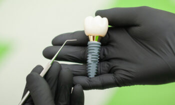 dental implant material